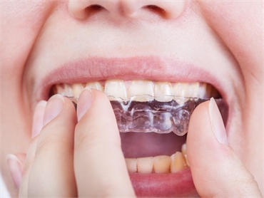 Factors why you will need to use a mouth guard for tooth grinding