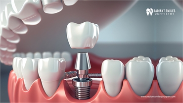 Types of Dental Implant 