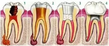 About Root Canal Treatment