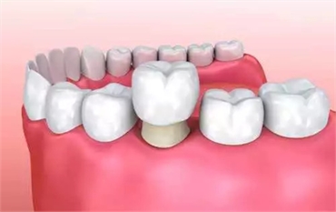 Dental Crowns at Sabka Dentist