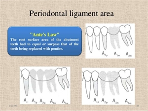 Ante's law in dentistry advocates that, when planning a dental bridge, the ratio of the crown and root of the abutment teeth should be equal or greater to the surface of the teeth being restored