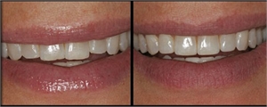 Tooth recontouring