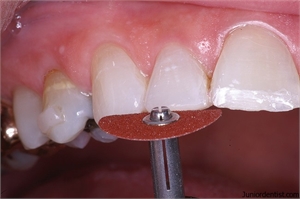 Teeth slenderizing