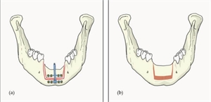 Distraction Osteogenesis is used to navigate bone growth and increase volume and height of the alveolar ridge