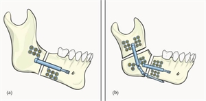 A - Unidirectional distractor B - Bidirectional distractor
The device can navigate bone growth in different directions