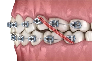 A Guide to Braces: Who Needs Braces and When to Get Them?