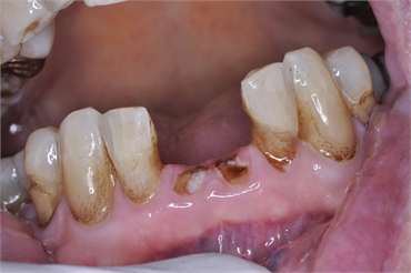 Do tooth roots need to be removed