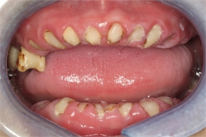 Teeth roots retained in the mouth jawbone