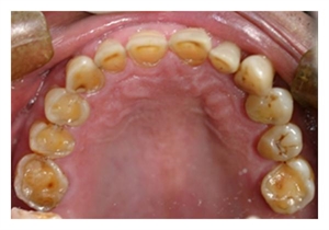 Teeth erosion caused by stomach acid reflux