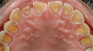 Enamel of teeth is eroded because of stomach acid reflux through the esophagus into the oral cavity