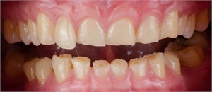 What is thegosis in dentistry?