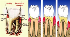 The main cause of these diseases is bacterial plaque, a sticky, colorless film that constantly forms on your teeth.