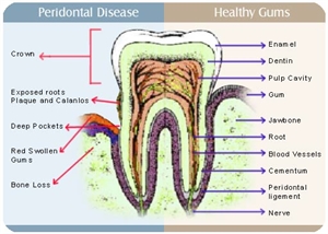  Cosmetic Gum Surgery Cost in Hyderabad India.