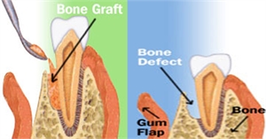 Bone Grafts Treatment Cost in Hyderabad India.