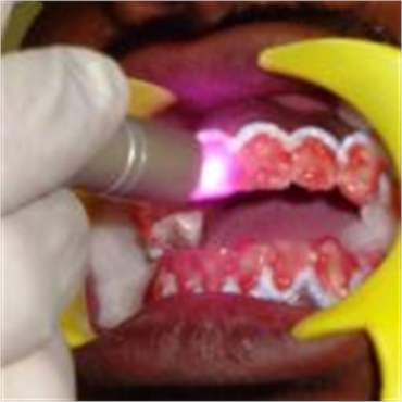 Laser Teeth Bleaching and Whitening in india.