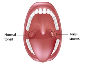 What are tonsil stones or tonsilloliths?