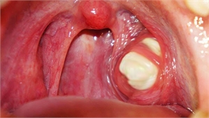 Large tonsil stone in patient's mouth
