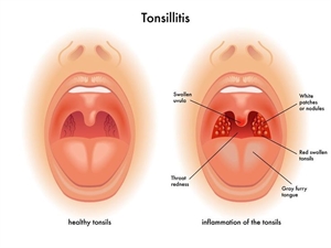 Tonsillitis and tonsil stones