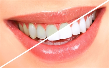 10 Ways to Whiten Your Teeth