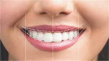 Digital Smile Design Transforming Cosmetic Dentistry