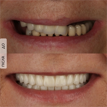 Complete treatment of the oral cavity