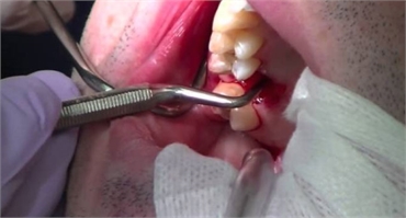 9 Signs You Should Get a Wisdom Tooth Extraction 