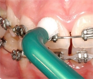 Interspace toothbrushing around braces