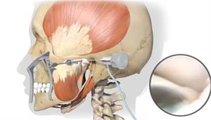 Arthroscopy of temporomandibular joint reveals the anatomical structures within the TMJ with the help of a micro camera