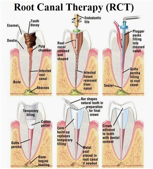 Root canal treatment (endodontic treatment) explained