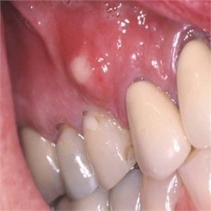 What is phoenix dental abscess?