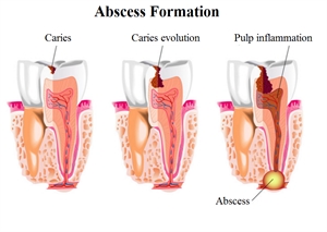 Abscess formation. Stages of forming a dental abscess.