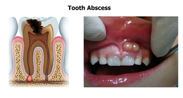 What is phoenix dental abscess? | News | Dentagama