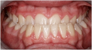 Anterior crossbite is a dental condition where the upper incisors are retruded back and the lower incisors are protuded forward