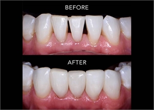 Dental black triangle treatment with dental crowns. Before and after correction of teeth black triangles