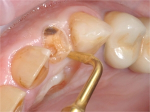 Piezosurgery is used in dentistry to treat both soft and hard tissues