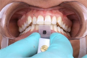 Leaf gauge in patient's mouth, checking the occlusal contacts