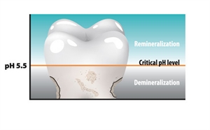 How to remineralize teeth