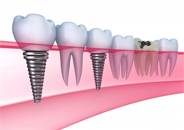 The Pros And Cons Of Dental Implants