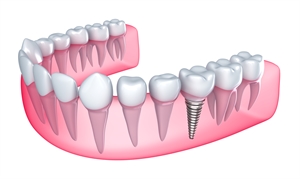 Dental Implants: Costs and Alternatives