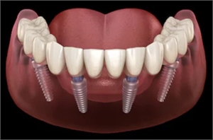 All on 4 dental implants