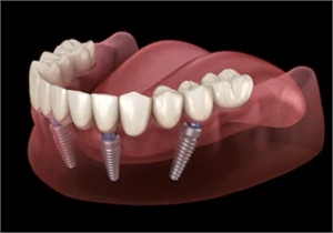 Prosthetic superstructure over dental implants