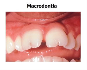 All you need to know about macrodontia