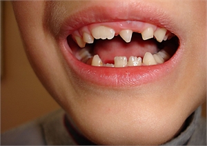 Macrodontic tooth on a young child. Macrodontia is a dental condition in which one or several teeth are significantly larger than the others.