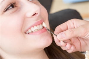 FAQs About Getting Dental Veneers in Melbourne