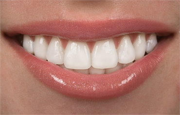 Get A Beautiful Smile With Porcelain Veneers 