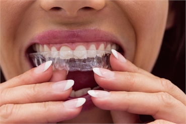 FAQs About Invisalign Answers And Straight from Experts
