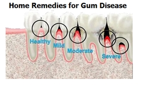 Home remedies for gum disease