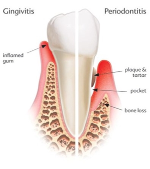 Difference between gingivitis and periodontitis (gum disease).