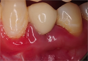 Red inflamed gum tissue around dental implant crown. Condition is called peri-implant mucositis