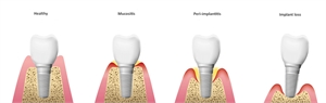 Difference between healthy implant, peri implant mucositis, peri implantitis and failing dental implant